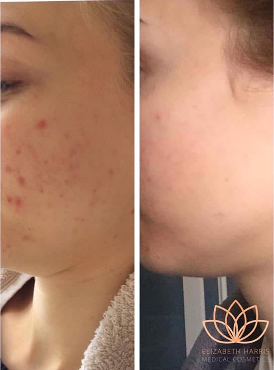 Before and after photo showing the results of skin peel treatment at the EH Medical Cosmetics clinic in Cowes, Isle of Wight.