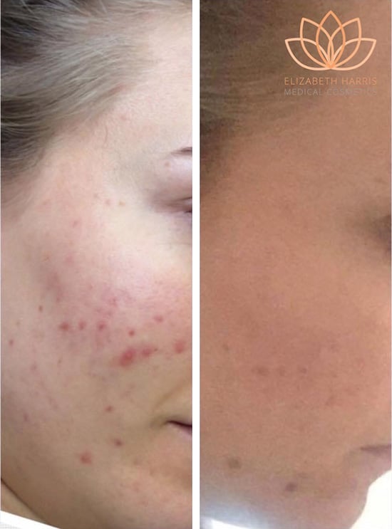Before and after photo showing the results of chemical peel treatment at the EH Medical Cosmetics clinic in Cowes, Isle of Wight.