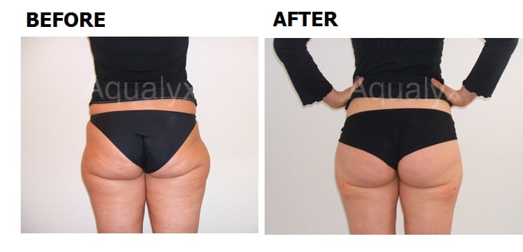 Before and after photo showing the results of fat loss treatment at the EH Medical Cosmetics clinic in Cowes, Isle of Wight.