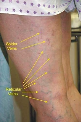 The different types of leg veins that can be treated by Microsclerotherapy at the EH Medical Cosmetic clinic in Cowes on the Isle of Wight.
