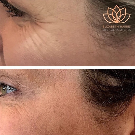 Before and after photo showing the results of wrinkle treatment at the EH Medical Cosmetics clinic in Cowes, Isle of Wight.