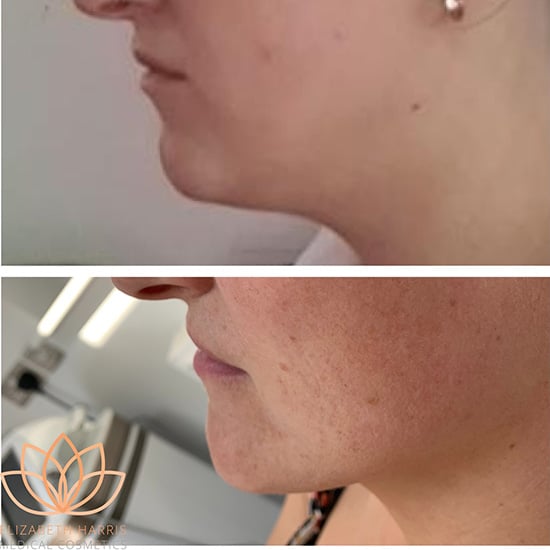 Before and after photo showing the results of Aqualyx treatment at the EH Medical Cosmetics clinic in Cowes, Isle of Wight.