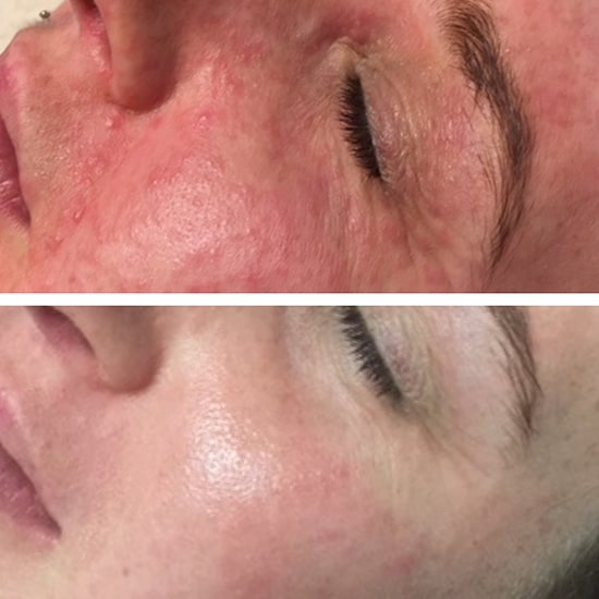 Before and after photo showing the results of Dermalux Flex LED at the EH Medical Cosmetics clinic in Cowes, Isle of Wight.