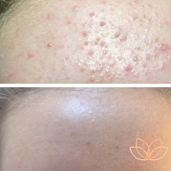 Before and after photo showing the results of Dermalux treatment at the EH Medical Cosmetics clinic in Cowes, Isle of Wight.
