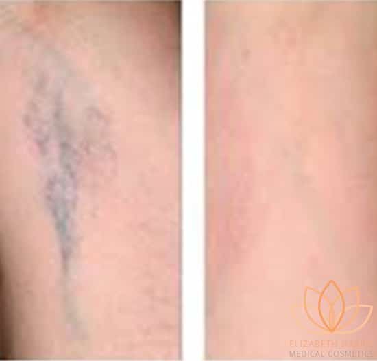 Before and after photo showing the results of leg vein removal at the EH Medical Cosmetics clinic in Cowes, Isle of Wight.