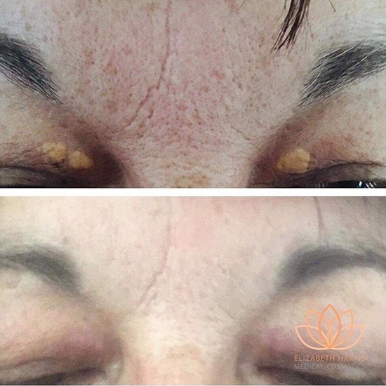 Before and after photo showing the results of Plasma BT treatment at the EH Medical Cosmetics clinic in Cowes, Isle of Wight.