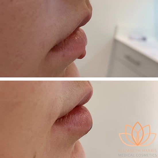 Before and after photo showing the results of radio frequency skin tightening at the EH Medical Cosmetics clinic in Cowes, Isle of Wight.