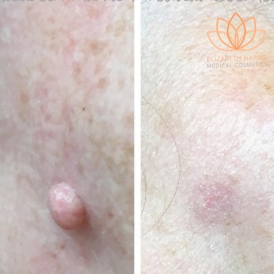efore and after photo showing the results of Plasma BT surgical treatmen at the EH Medical Cosmetics clinic in Cowes, Isle of Wight.